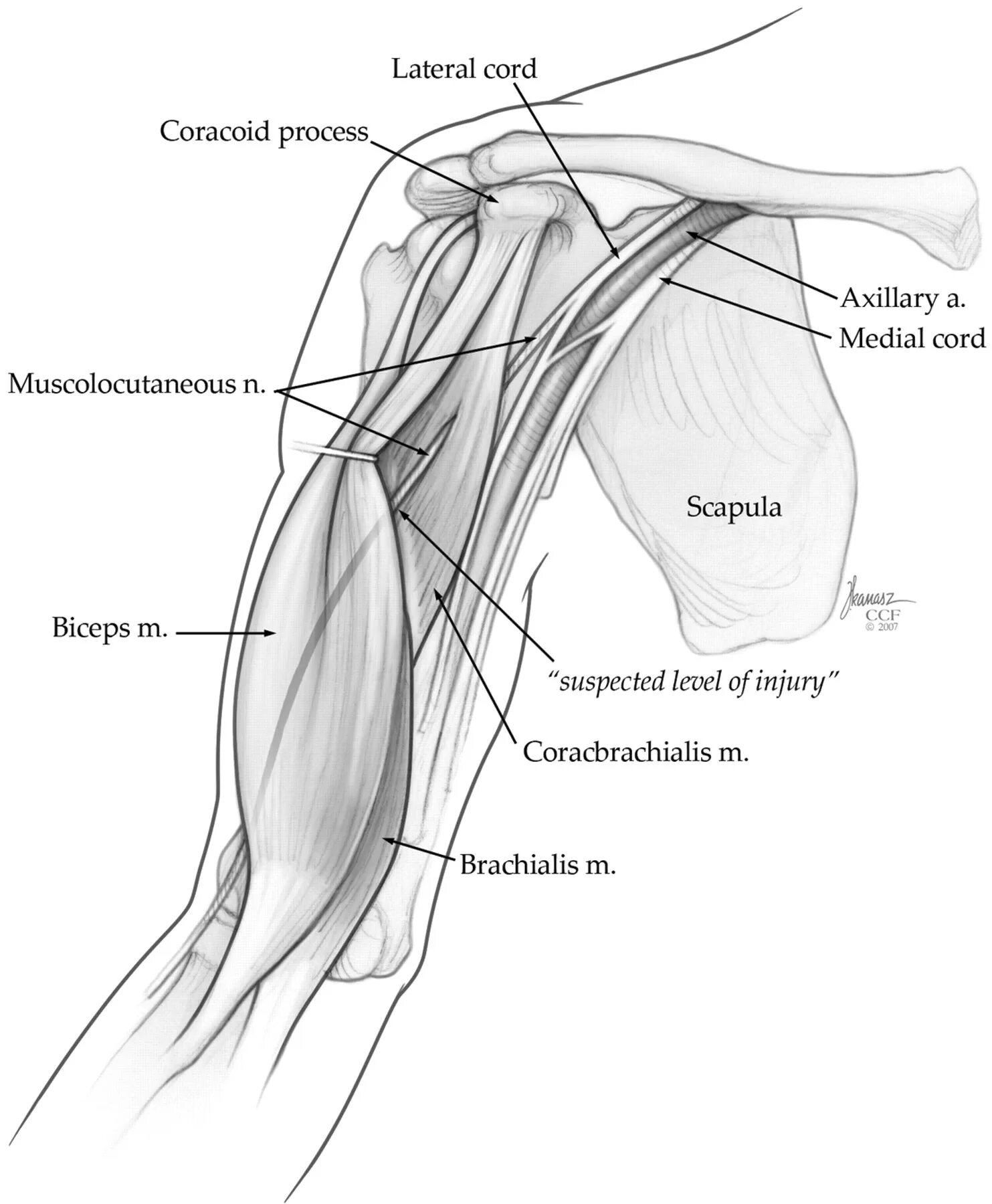 Нервы бицепса. Кожно мышечный нерв плеча анатомия. Мышечно кожный нерв топография. Нерв на плече топографическая анатомия. Латеральный кожный нерв плеча.