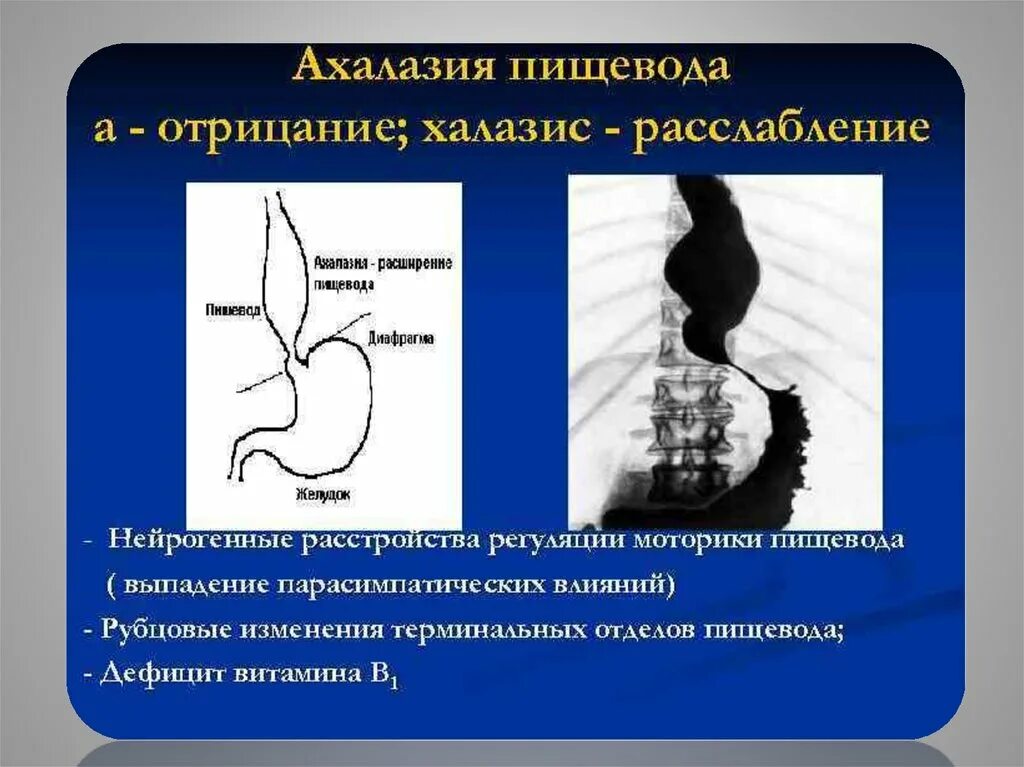 Халазия пищевода. Кардиоспазм и ахалазия пищевода рентген. Халазия пищевода этиология. Ахалазия степени рентген. Ахалазия желудка рентген.