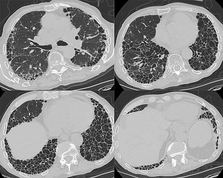 Идиопатический фиброзирующий альвеолит кт. Идиопатический легочный фиброз кт. Идиопатический пневмофиброз. Фиброзирующий альвеолит кт картина.