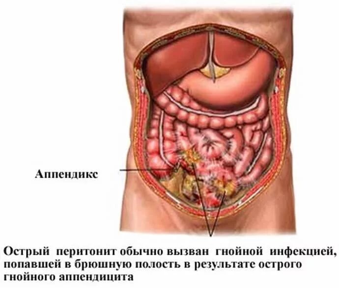 Аппендицит низ. Острый аппендицит спеританитом.