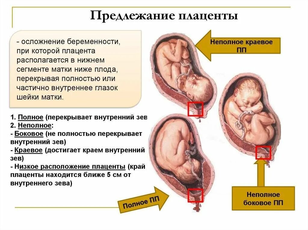 Низкое предлежание плаценты при беременности. Заднее предлежание плаценты при беременности. Нижнее предлежание плаценты при беременности. Предлежание плаценты боковое центральное. При низкой плацентации можно