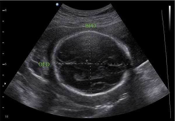 Бпр на узи при беременности. БПР 16 мм. БПР ЛЗР плода. УЗИ БПР плода что это. БПР 47 мм.