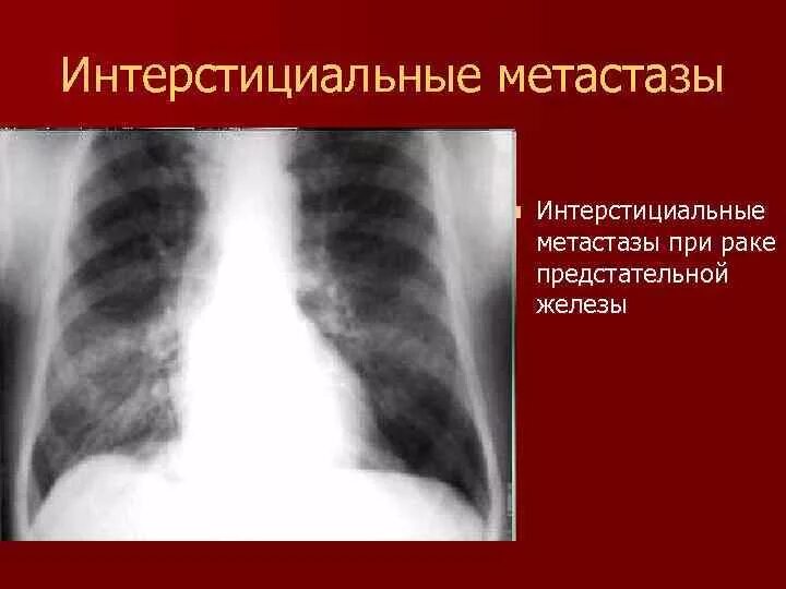 Рмж метастазы в легкие. Метастазы в предстательной железе. метастазы арка прдестательной делезы в кости. метастазы при онкологии.