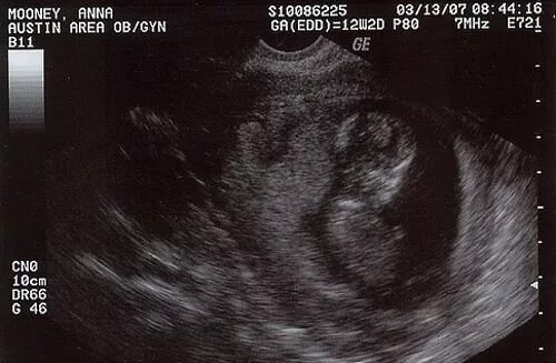 УЗИ 12 недель беременности. Эмбрион на 12 неделе беременности УЗИ. УЗИ 12 недель беременности фото. Как выглядит плод на 12 неделе беременности на УЗИ. 0 12 недель