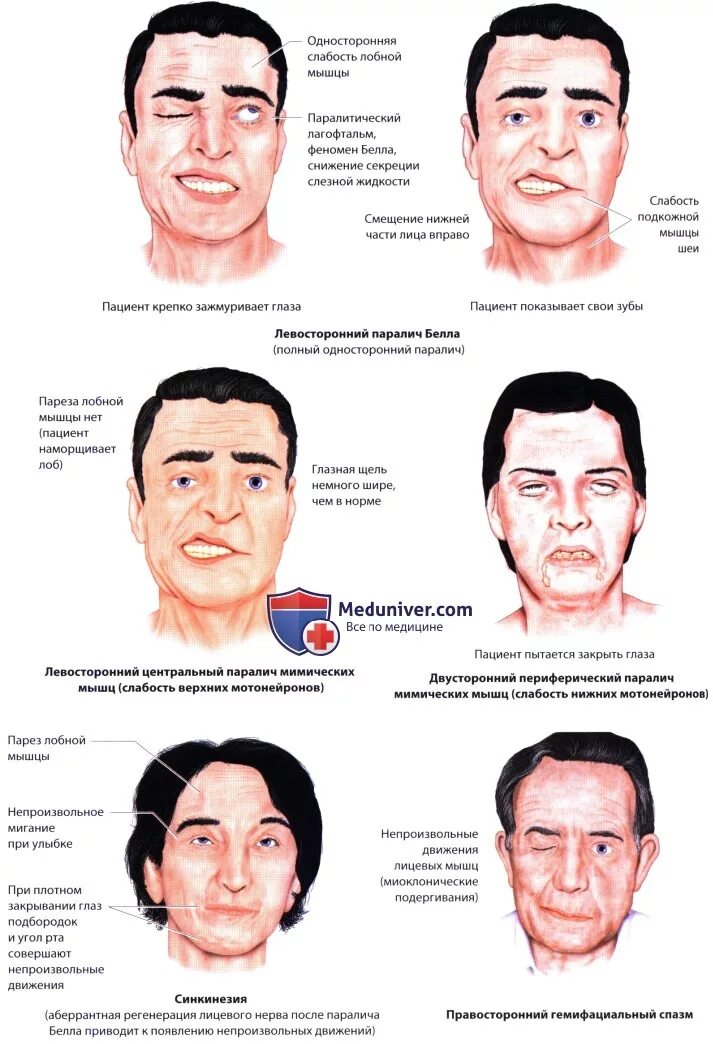 Порез лицевого. Центральный парез 7 нерва. Центральный и периферический паралич лицевого нерва. Дифференциальная диагностика периферического пареза лицевого нерва.
