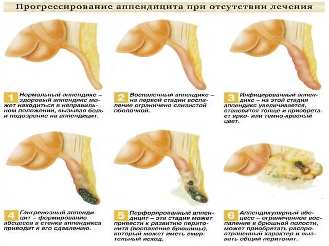 Как проверить аппендицит или нет. Начальные признаки аппендицита. ранние признаки аппендицита. симптомы аппендицита у женщин. признаки аппендицита у женщин.
