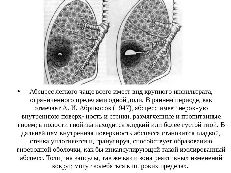 Механизм развития абсцесса легкого. Этиология при абсцессе легкого. Абсцесс лёгкого патогенез. Аспирационный абсцесс легкого. 1 абсцесс легкого