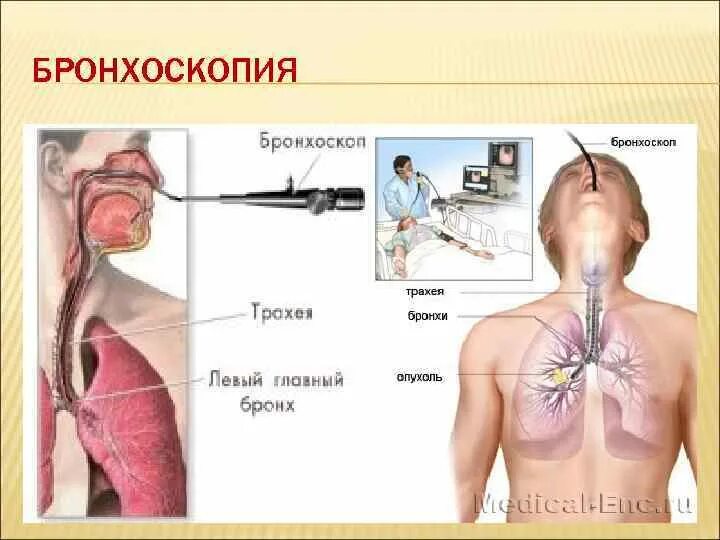 Бронхоскопия мокроты. Бронхоскопия и бронхография. Бронхоскопия легких через нос.