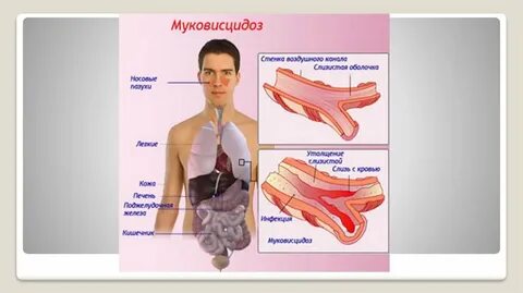 Муковисцидоз люди