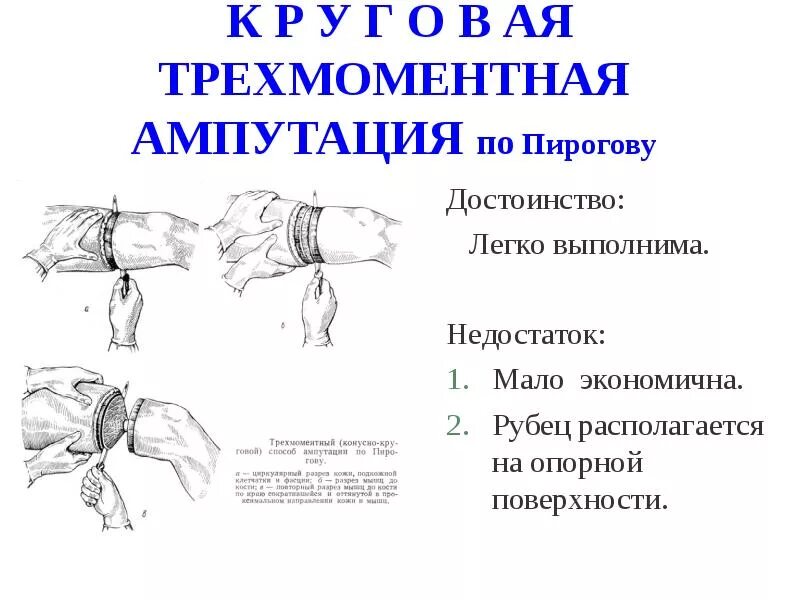 Конусно круговой способ ампутации Пирогова. Конусно круговая ампутация бедра по Пирогову. Трёхмоментная ампутация по Пирогову. Ампутация конечности операция.