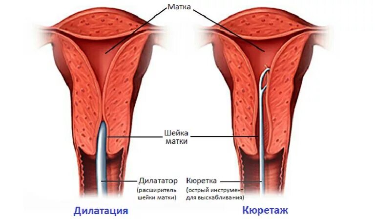 Раздельное выскабливание цервикального канала. Раздельное выскабливание цервикального канала