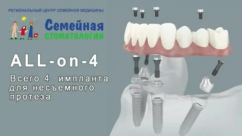 Импланты технология