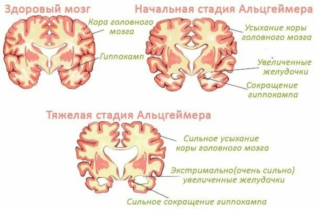 Болезни мозга степени. Болезнь Альцгеймера. Мозг при болезни Альцгеймера. Болезнь Альцгеймера стадии заболевания. Стадии Альцгеймера.