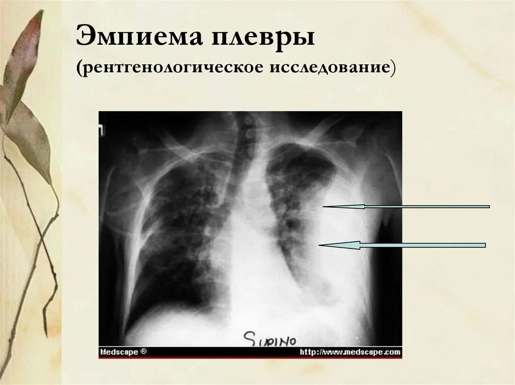 Эмпиема легкого. Гнойный плеврит (эмпиема). Острый Гнойный плеврит ( эмпиема плевры). Этиология. Хроническая эмпиема плевры рентген. Гнойный плеврит рентген.