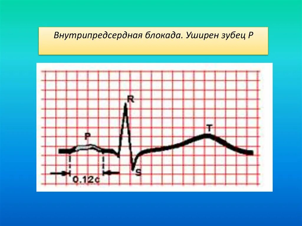 Что значит внутрипредсердная внутрипредсердная блокада. Внутрипредсердная блокада на ЭКГ. Внутри предсеодная блокада. Степени внутрипредсердной блокады. Для внутрипредсердной блокады характерно.