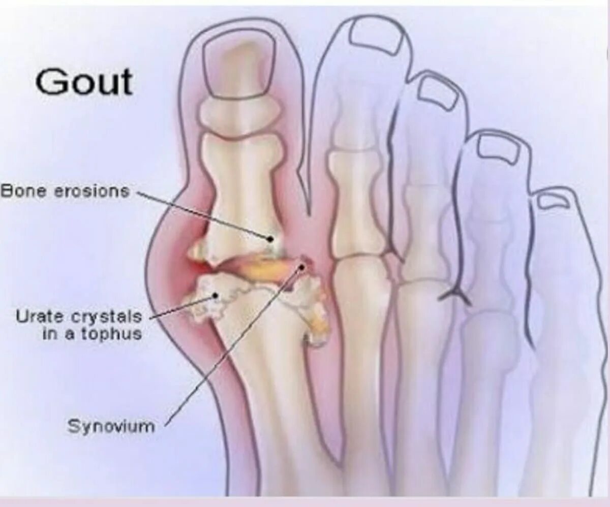 Болит основание сустава большого пальца. Сустав большого ральца ноги приподагре. Ревматоидный артрит плюснефалангового. Плюснефаланговый сустав подагра.