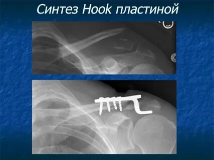 Остеосинтез ключицы