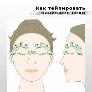 Нависшее веко тейпирование