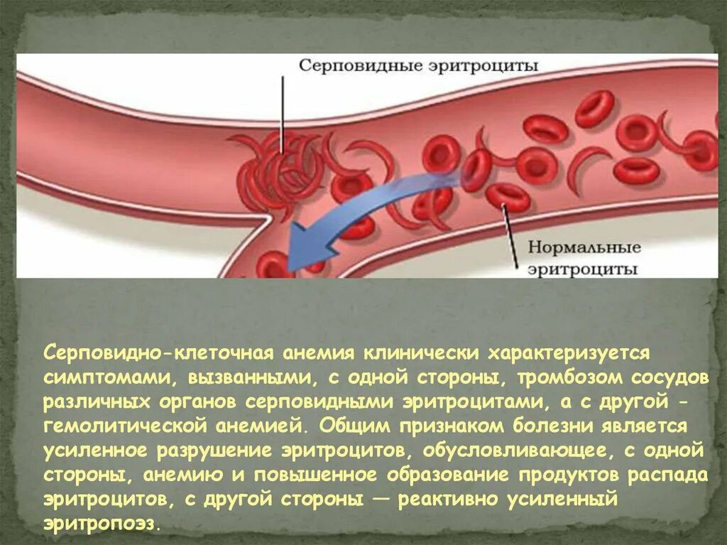 Серповидно клеточная анемия признаки. Серповидноклеточная анемия эритроциты. Серповидная клеточная анемия симптомы. Эритроциты при серповидноклеточной анемии. Серповидноклеточная анемия характеризуется.