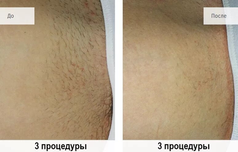 Лазерная эпиляция волосы выпадают через. После лазерной эпиляции. лазерная эпиляция после 1 процедуры. волосы после сеансов лазерной эпиляции.