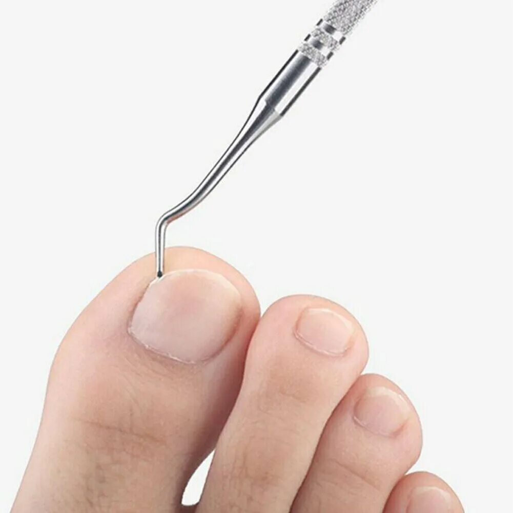 Педикюр нитью. Корректор для вросших ногтей с АЛИЭКСПРЕСС. Инструмент для вросших ногтей на ногах. Инструмент для педикюра вросший ноготь. Педикюрные инструменты для вросшего ногтя.