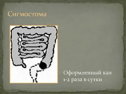Трансверзостома