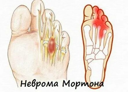 Болит под большим