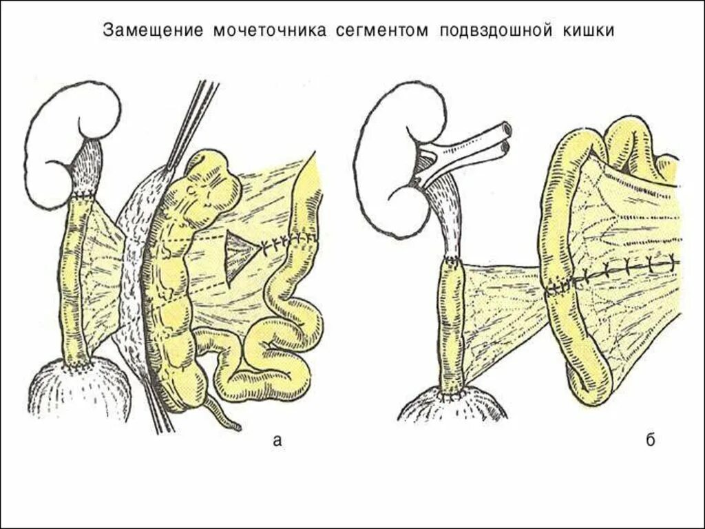 Сегмент кишка. Замещение мочеточника сегментом тонкой кишки. Пластика мочеточников операции. Новообразование мочеточника.