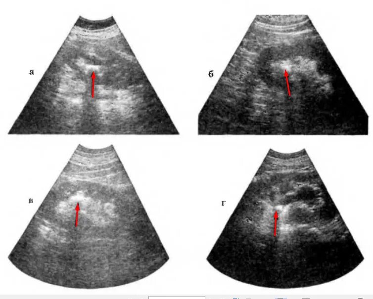 Акустические тени в почках. Нефролитиаз почек на УЗИ. Конкременты в почках на УЗИ что это такое. Расширение лоханки почки на УЗИ. Камни в почках на УЗИ.