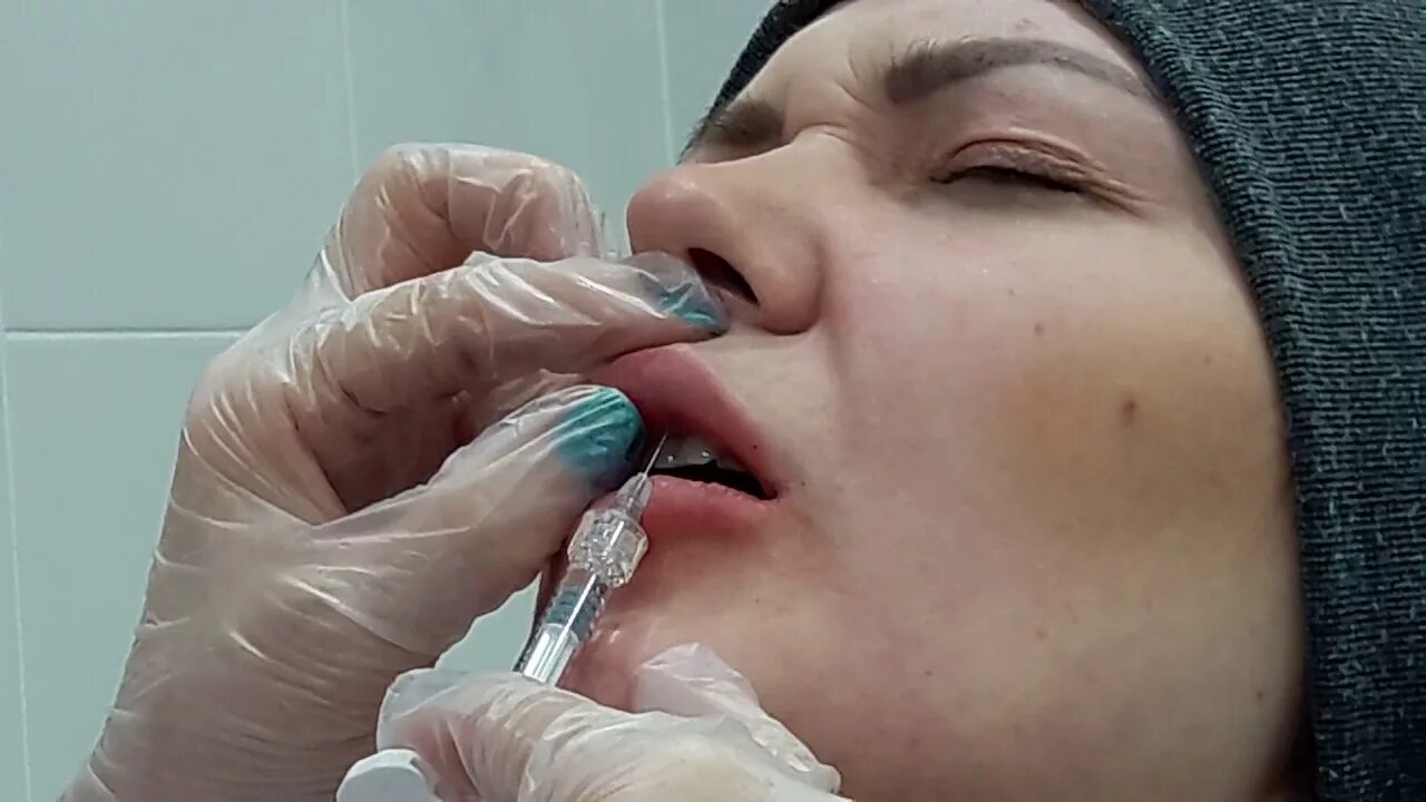 Почему филлеры в губах быстро рассасывается