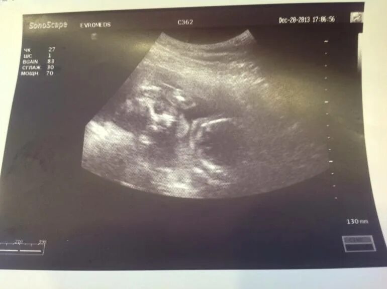 Двадцать недель беременности. Ребенок в животе 20 недель. Двадцать недель беременности. Фото плода на 20 неделе беременности фото. Двадцать недель беременности.