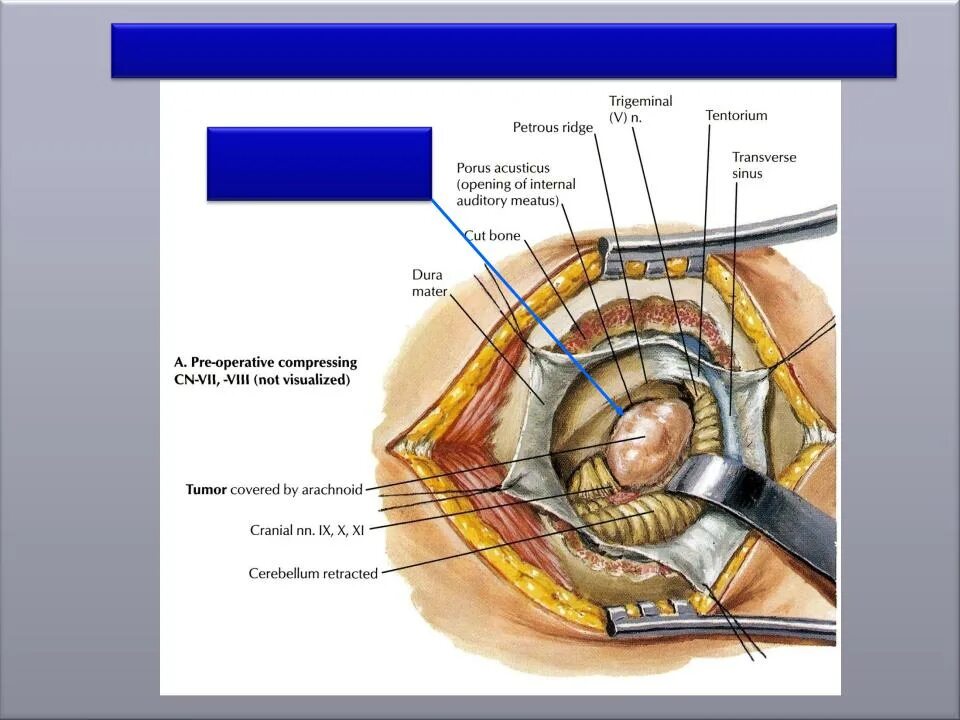 Мосто-мозжечковый угол анатомия. Опухоли мосто-мозжечкового угла. Образование мостомозжечкового угла. Мостомозжечковый угол опухоль. Мозжечковая опухоль