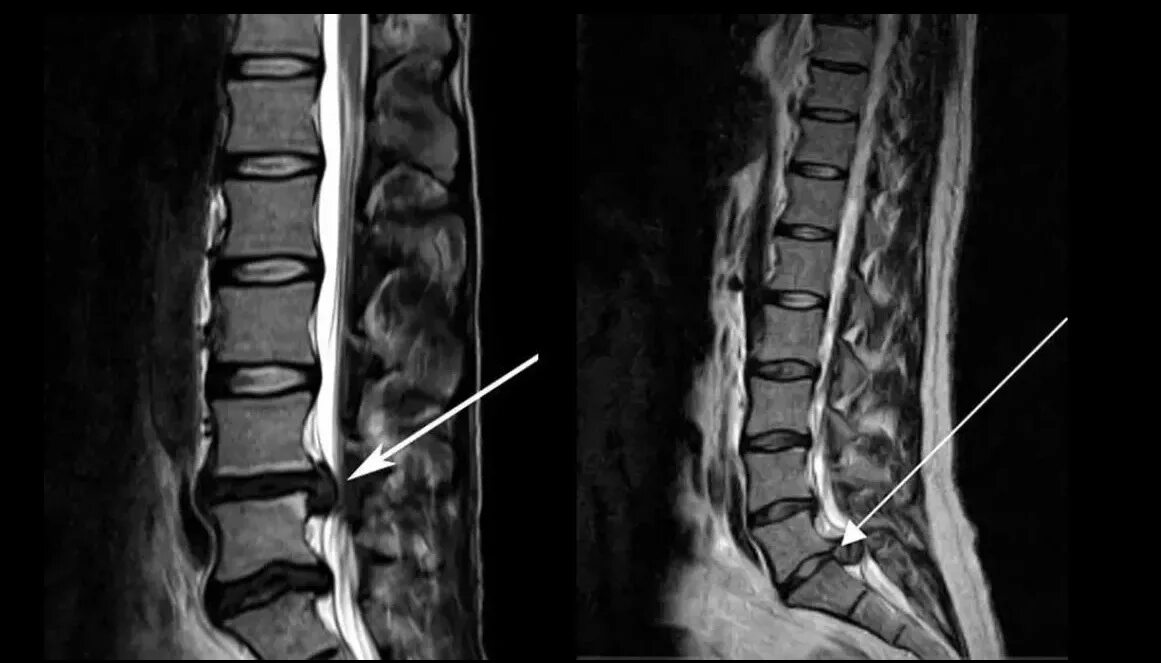 Протрузия шейного отдела позвоночника мрт. Мрт позвоночника пояснично-крестцового отдела (l1-s1). Межпозвонковая грыжа снимок мрт позвоночника. Невринома поясничного отдела позвоночника мрт. Пояснично крестцовый отдел операция на позвоночнике