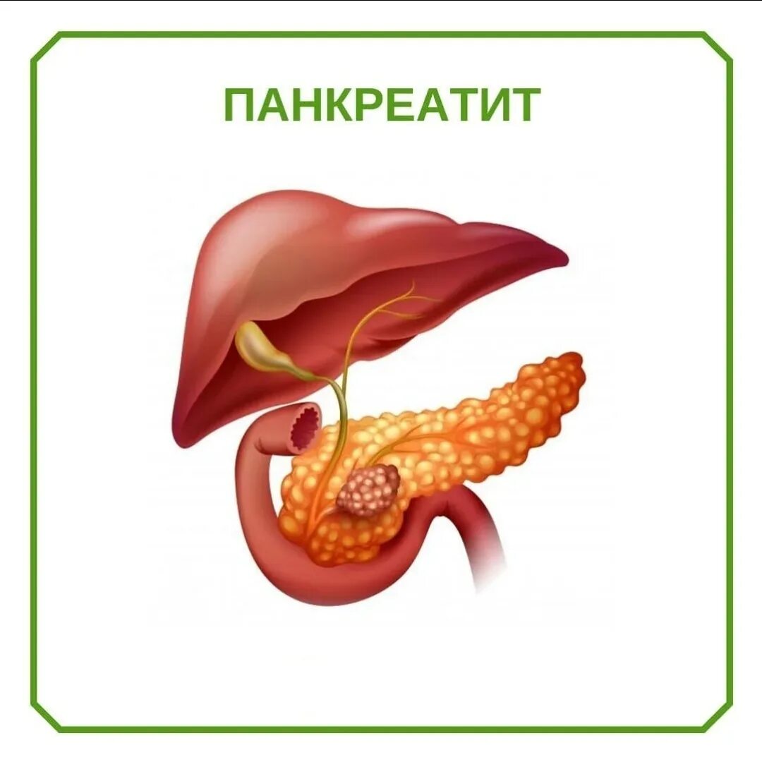 Панкреатит что это такое простыми словами лечение. Острый панкреатит поджелудочной железы. Панкреатин поджелудочная железа. Панкреатит это заболевание. Болезнь острый панкреатит.