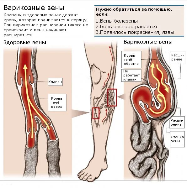 Вышла вена. Варикозное расширение вен схема. варикозная вена в разрезе.