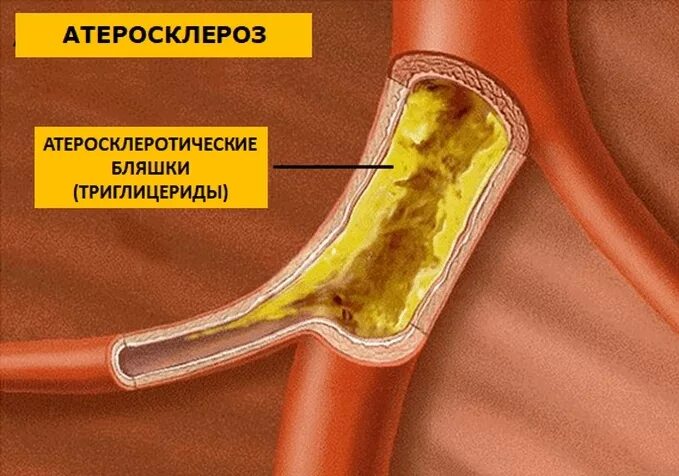 Атеросклерозная бляшка в сосуде. Холестериновые бляшки на лице. Холестериновые бляшки на коже. Бляшки уменьшились. Холестериновые бляшки в сосудах.