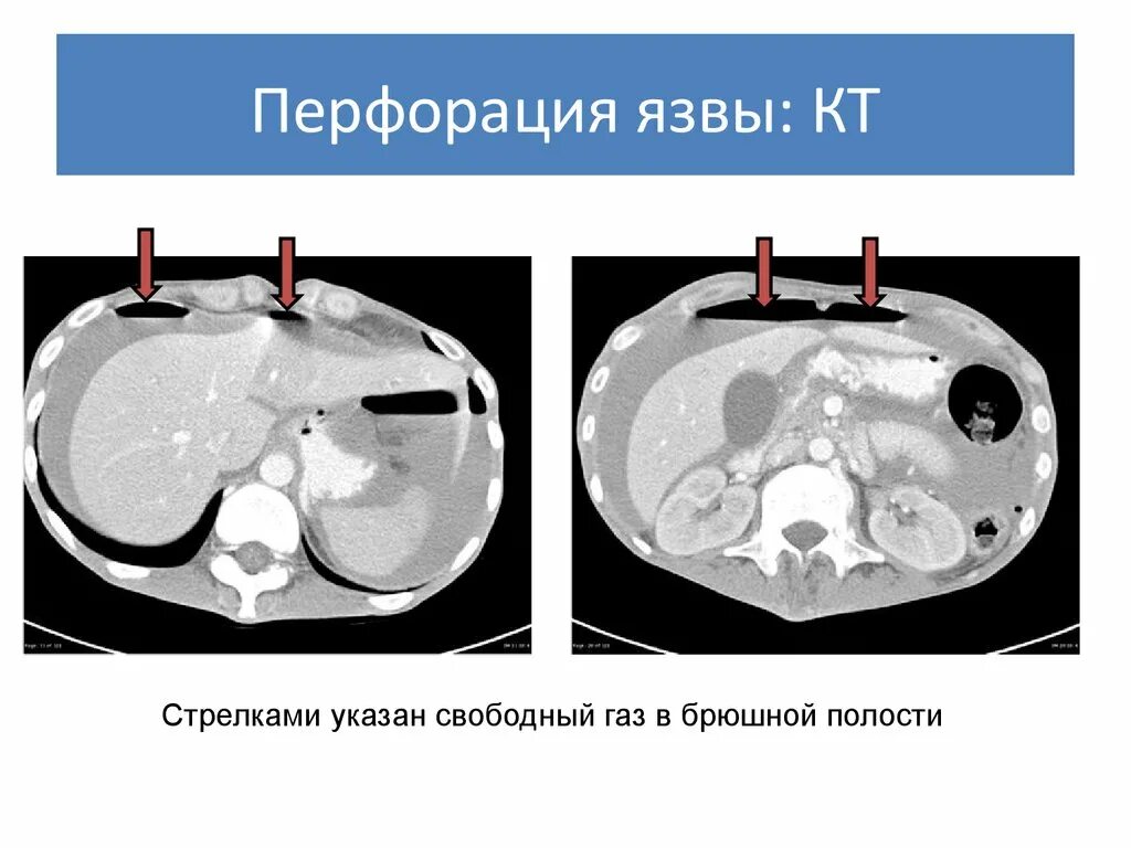 Язва кт