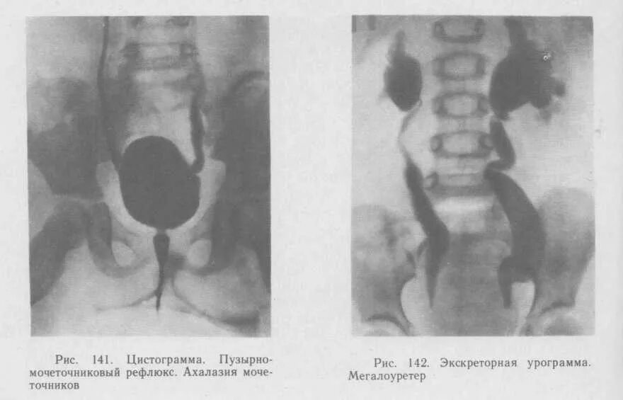 Интрамуральный мочеточник. Удвоение мочеточника рентген. Нейромышечная дисплазия мочеточника. Расширенное Устье мочеточника.