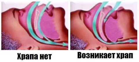 Появился храп причины