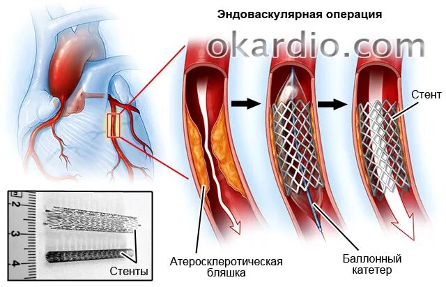 Шунт сосудов. Коронарное стентирование сосудов сердца. Баллонная ангиопластика и стентирование. Стентирование сосудов эндоваскулярное. Шунтирование стентирование протезирование.