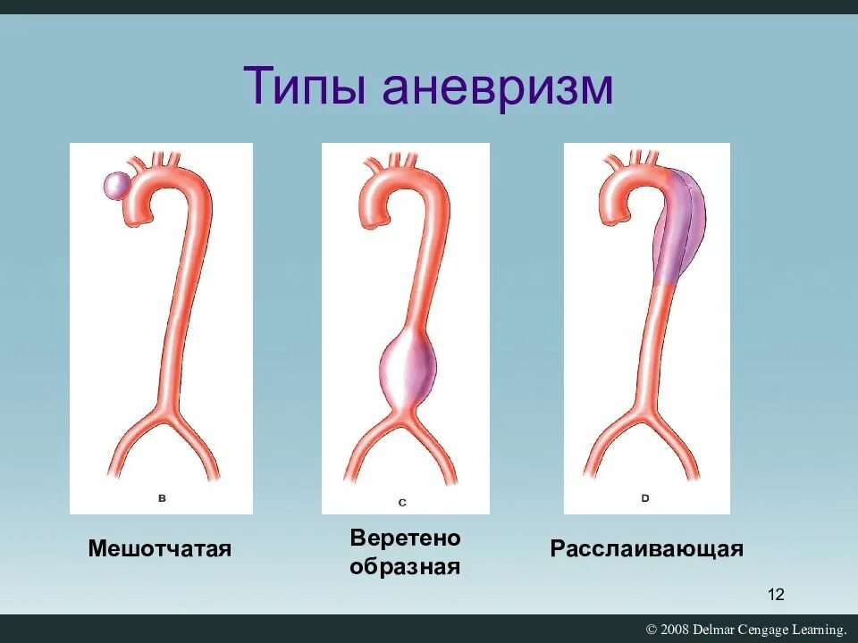 Мешотчатая аневризма внутренней. Мешотчатая аневризма внутренней