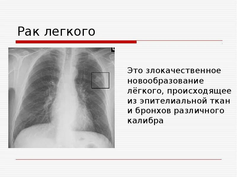 Стадии рака бронха. Новообразование в легком. Злокачественная опухоль легких.