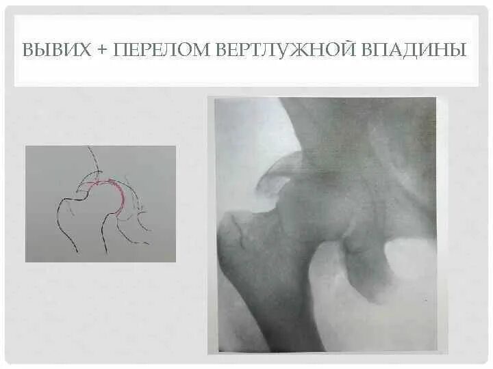 Перелом тазобедренной впадины. Перелом дна вертлужной впадины на рентгене. перелом вертлужной впадины тазобедренного сустава. перелом вертлужной впадины рентген. вывих вертлужной впадины.