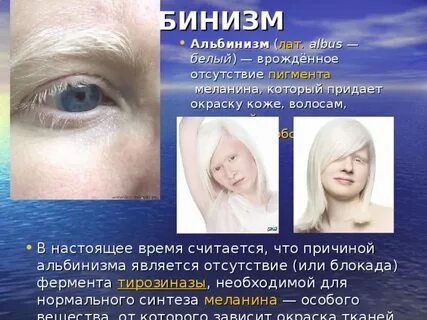 Отсутствие пигмента меланина