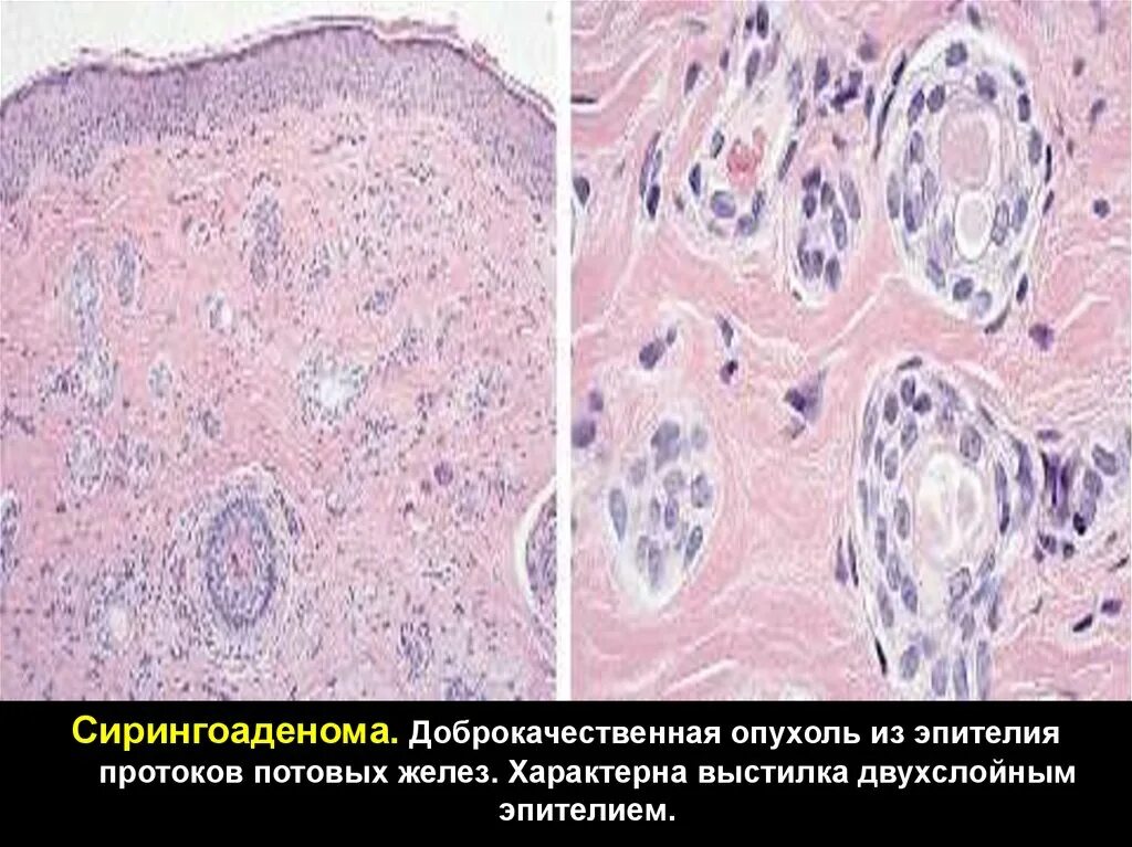Муцинозная аденокарцинома яичника гистология. Папиллома кожи патанатомия. Злокачественные органоспецифические опухоли. Доброкачественные и злокачественные опухоли эпителия. Опухоли эпителия.