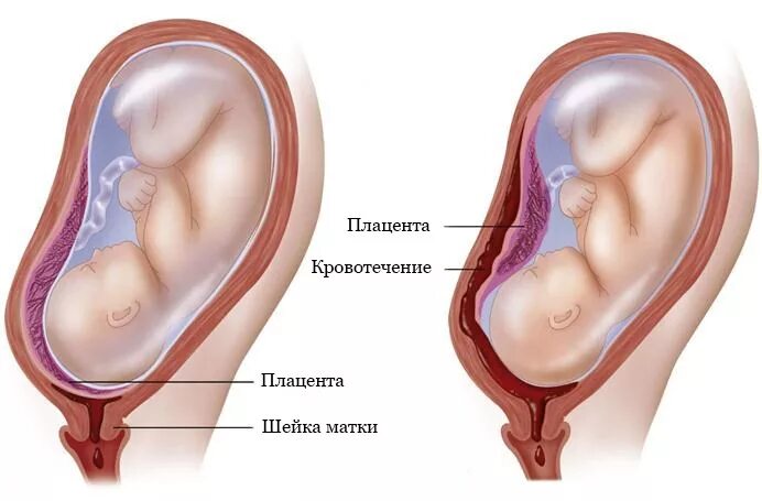 Плацента по передней стенке матки при беременности. Хорион плацента матка. Головное предлежание плода плацента по передней стенке. Переднее прикрепление плаценты. При низкой плацентации можно