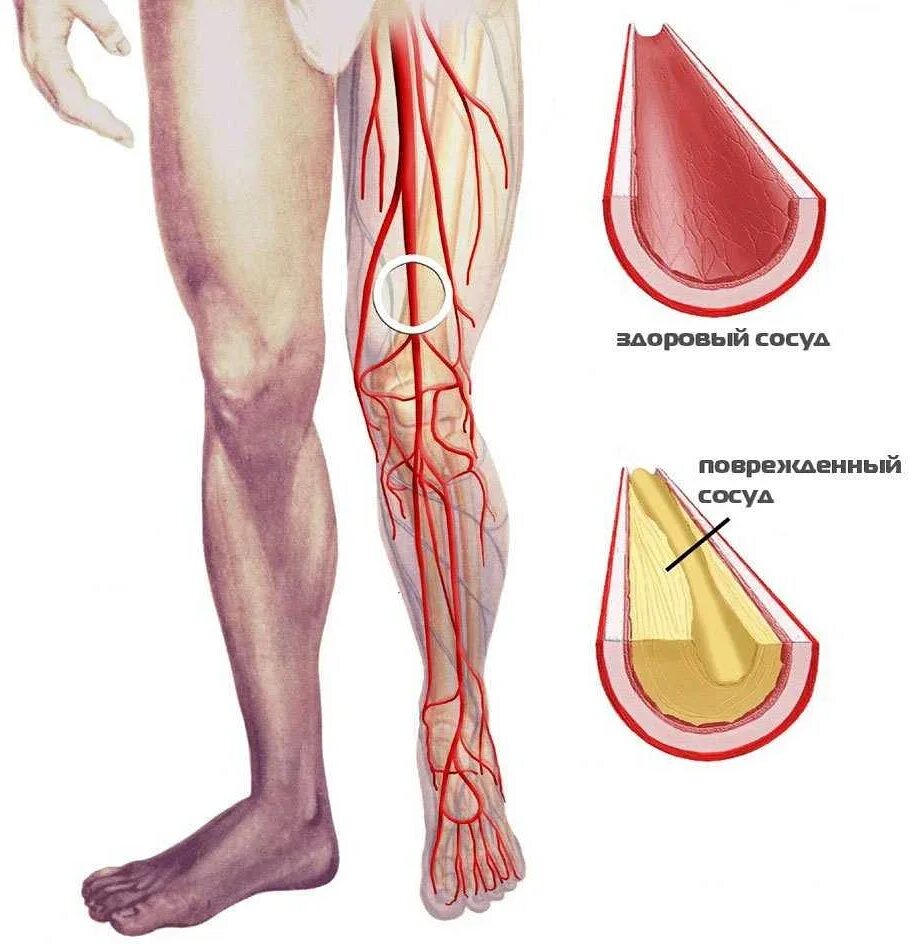 Сосудистые больные. Облитерирующий атеросклероз сосудов конечностей. Облитерирующий атеросклероз артерий нижних конечностей. Клинические симптомы атеросклероза сосудов нижних конечностей. Облитерирующий атеросклероз артерий нижних конечностей ноги.