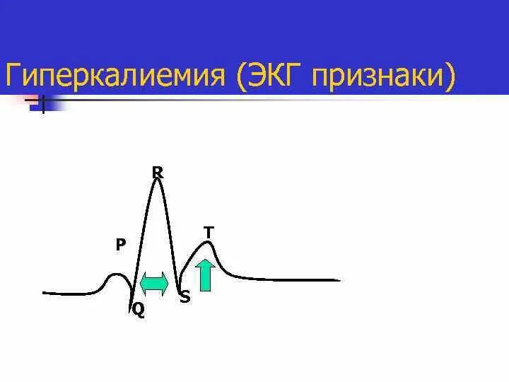 Гиперкалиемия что. Гиперкалиемия зубец т. ЭКГ при гипокалиемии и гиперкалиемии. Проявления гиперкалиемии на ЭКГ. ЭКГ критерии гиперкалиемии.