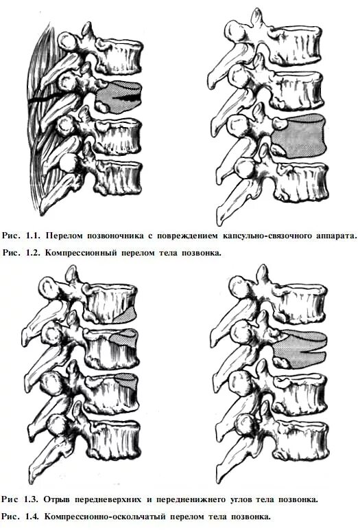 1. Компрессионный перелом тела позвонка. Механизм компрессионного перелома позвоночника. Компрессионный перелом тела позвонка схема. Компрессионные переломы тел позвонков классификация.