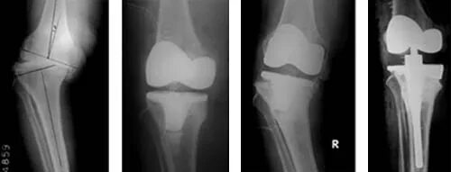 Мрт после эндопротезирования. Тотальное эндопротезирование коленного сустава рентген. Нестабильность коленного эндопротеза рентген. Эндопротез коленного сустава рентген. Ревизионное эндопротезирование коленного сустава.
